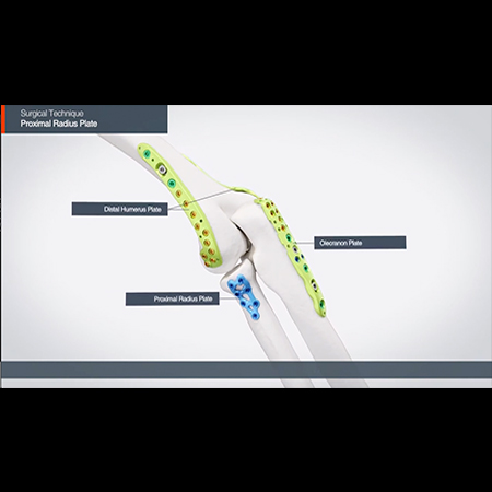 Proximal Radius Plate 수술 기법 3D 영상 - 홍보영상 포트폴리오